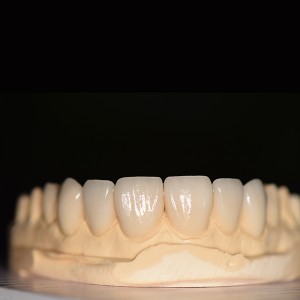 non-prep emax veneer