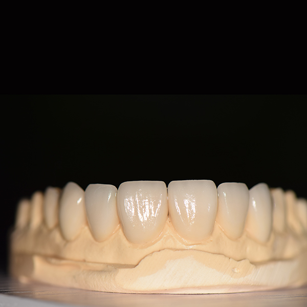 Color Steel Dental Implant Drill -
Non-prep E-max veneers – Foo Tian detail pictures