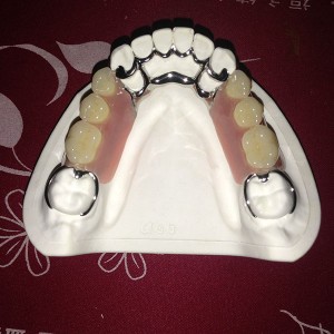 Corrugated Aluminum Oral Health -
 Cobalt Chrome Casting Framework denture – Foo Tian