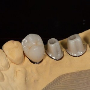 zirkonazko Abutment