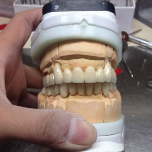 Wrinkle Embossed Ppgi Carbon Steel Probe Dental Care Kit - PFM bridge – Foo Tian