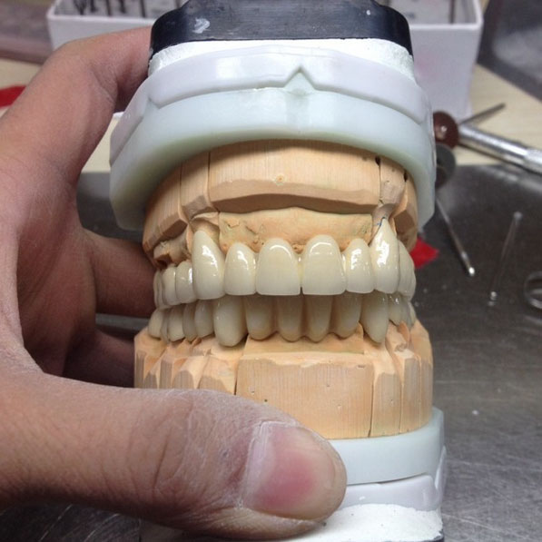 Iron Coil Apex Locator Endodontic -
 PFM bridge – Foo Tian