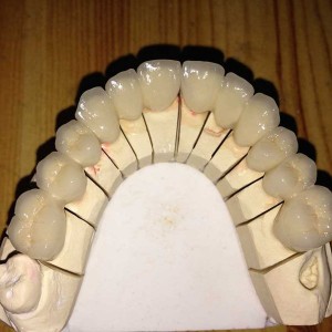 Full arch metal ceramic bridge