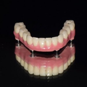 Full arch implant bridge