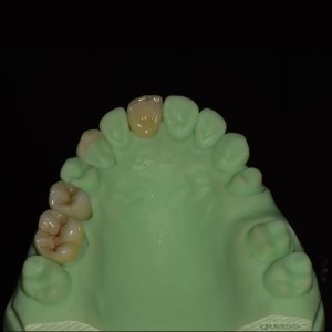 full contour zirconia full ceramic crown and bridge