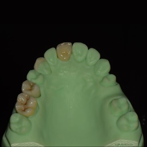 Matt Ppgi For Building Materials Titanium Dental Implants -
 Full contour Zirconia Crown – Foo Tian