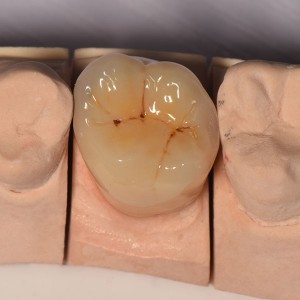 Tinplate T3 Dental Impression -
 Crown – Foo Tian