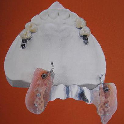 Corrugated Alloy Metal Sheet Dental Amalgam Alloy -
  Bridge With Attachments – Foo Tian