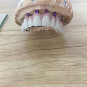 Full Arch implant case