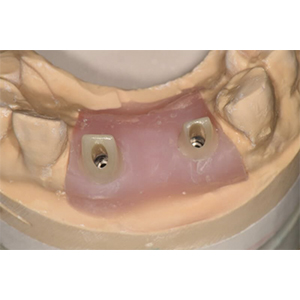 Alu-Zinc Steel Plate Dental Drill - Full Ceramic Zirconium Abutment with Ti-base – Foo Tian