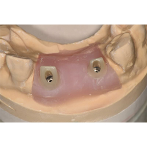 Full Ceramic Zirconium Abutment with Ti-base