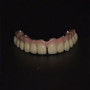 Individualized full arch implant bridge