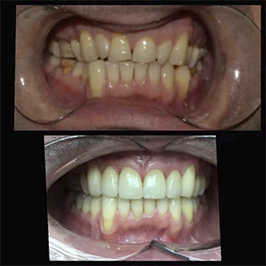 Natural Look Emax Crown&Veneer Work