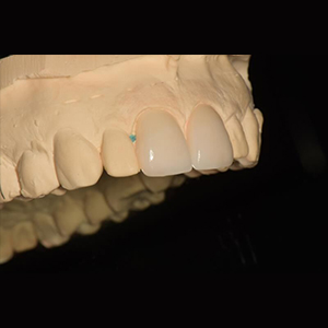 Etp Tinplate Sheet Dental Intraoral Camera With Monitor - ceramic veneer – Foo Tian