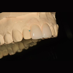 ceramic veneer