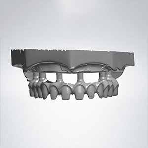 Alu-Zinc Roof Steel Denture Retainer Box -
 digital design of full arch implant work  – Foo Tian