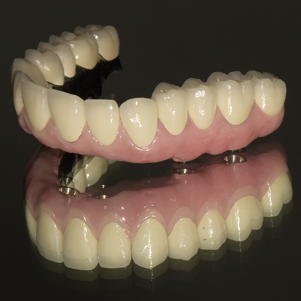 Matt Pre-Painted Steel Dental Composite Restoration -
 CAD CAM Malo implant bridge – Foo Tian