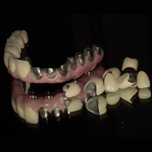 CAD CAM Malo full arch implant bridge